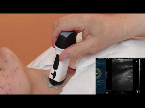 Professor Fabrizio Calliada - Thyroid Ultrasound with Cerbero4.0 Wireless Ultrasound ATL