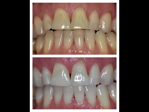 Bleaching mit Flaesh.