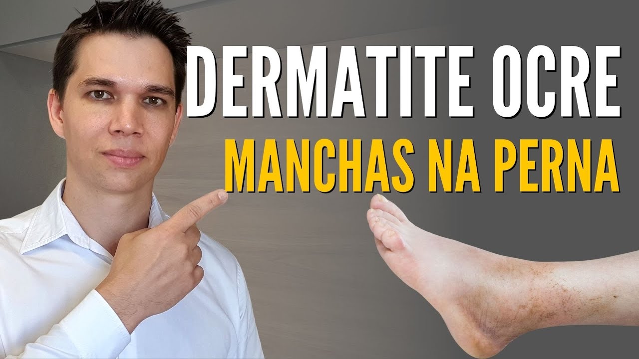 DERMATITE OCRE! Como clarear as manchas nas pernas?!