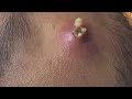 Super Big Acne | Mụn Nhọt Siêu Khổng Lồ Trên Trán Super Big Acne | Mụn Nhọt Siêu Khổng Lồ Trên Trán