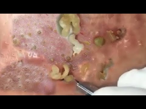 Deep Blackheads, Milia & Whitehead Removal pimple popping New| Big Cystic Acne Extraction 