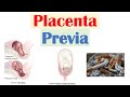 Placenta Previa (Low Lying Placenta) | Risk Factors, Symptoms & Complications, Diagnosis, Treatment