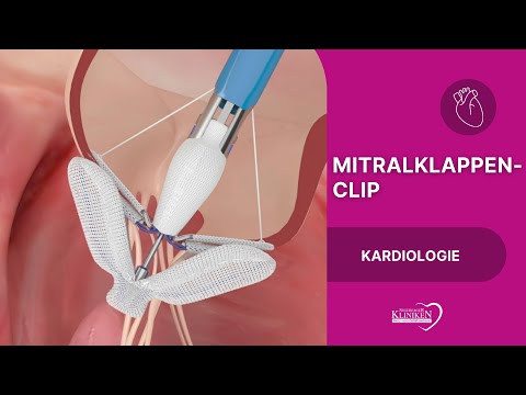 Mitralklappen Clip - Schonende Therapie bei Mitralklappeninsuffizienz