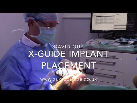 X-Guide dental implant placement intro by David Guy