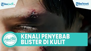 Apa itu Blister? Luka Melepuh pada Kulit yang Picu Infeksi, Inilah Penyebab yang Kerap Diabaikan