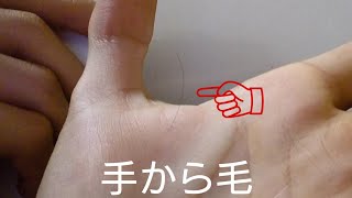 【珍百景】手のひらから毛が生えてきた