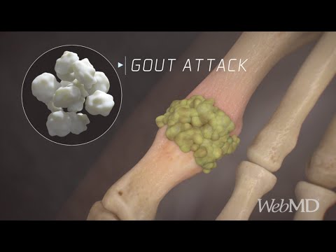 Gout Attack Explained: Causes, Symptoms, and Uric Acid Crystals | WebMD
