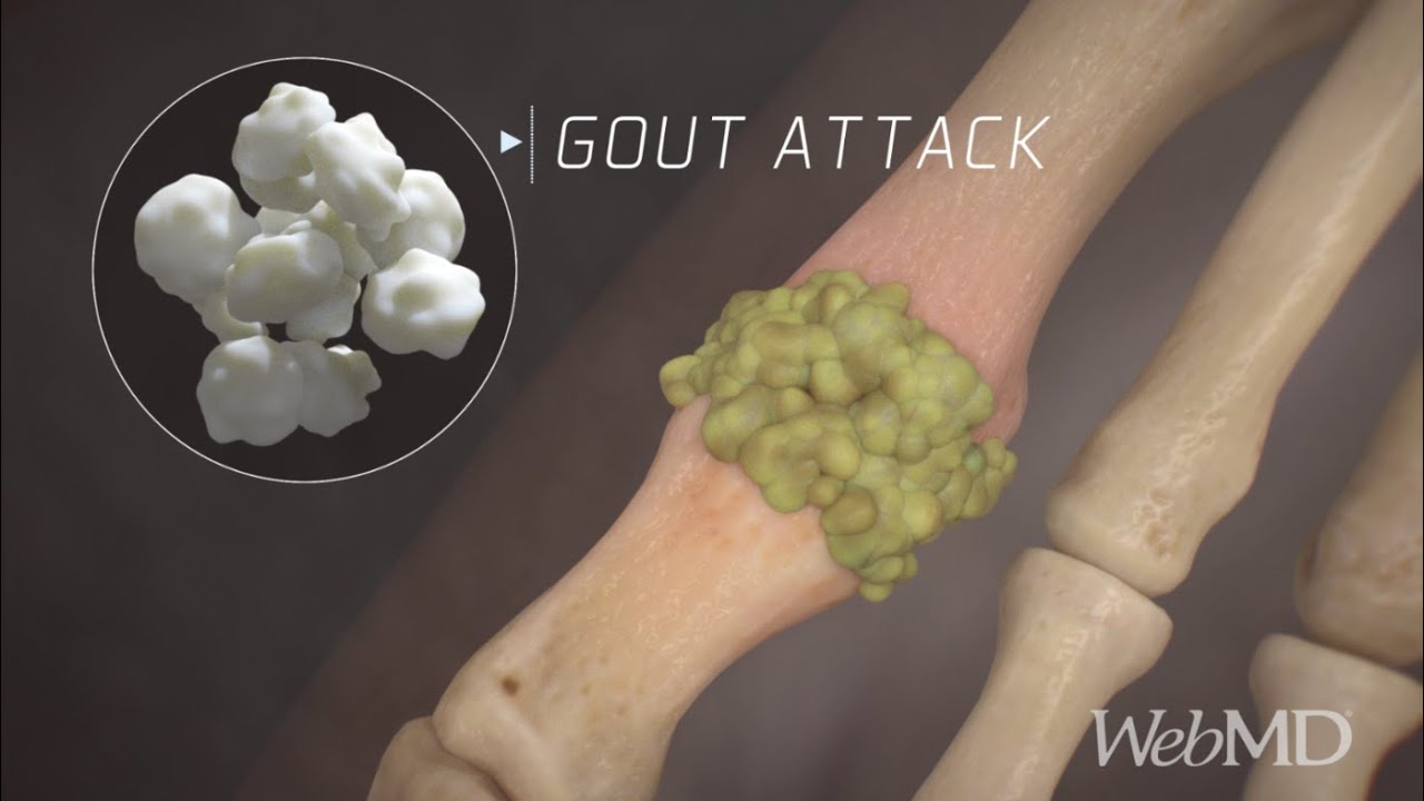Gout Attack Explained: Causes, Symptoms, and Uric Acid Crystals | WebMD