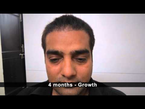 Best Hair Transplant At Hair & Senses