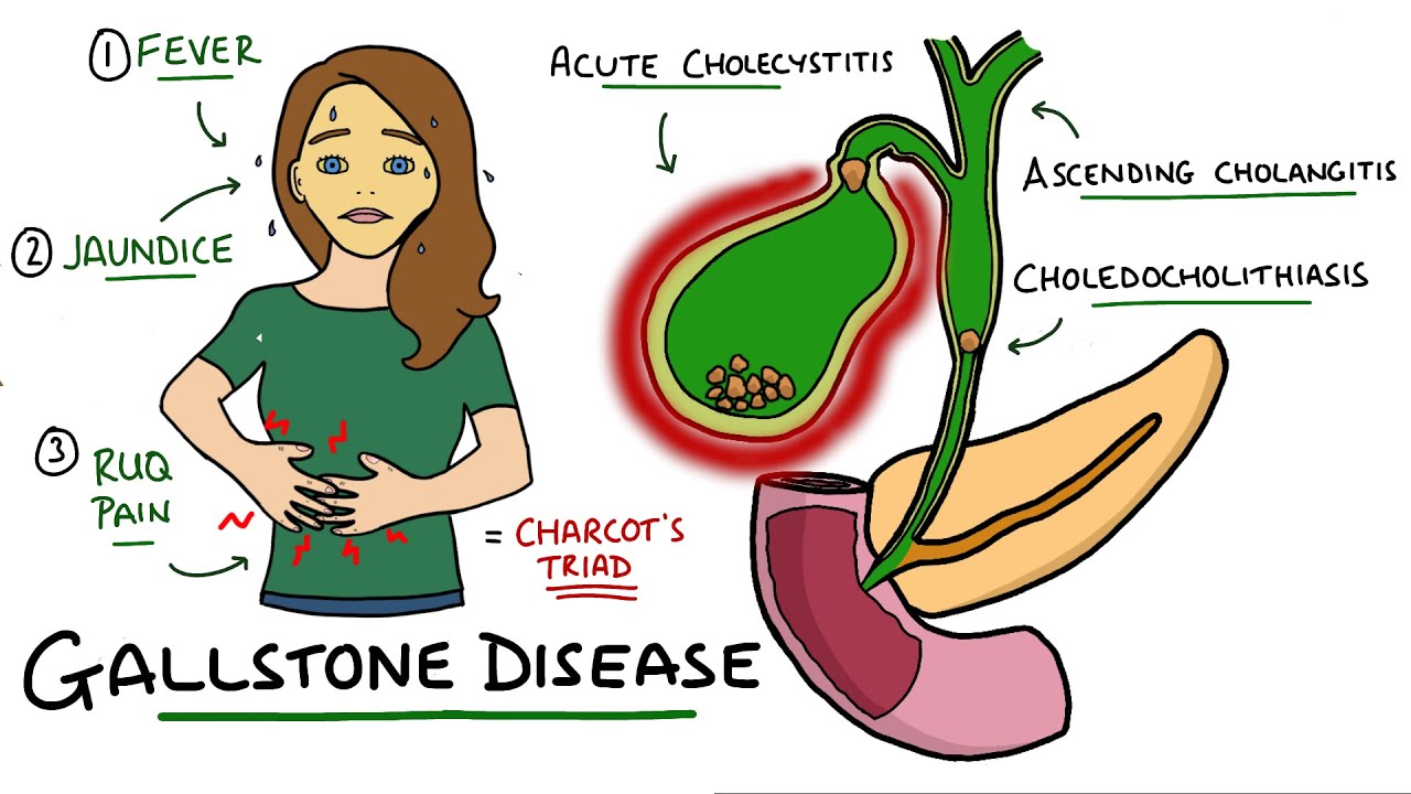 Gallstone Disease - Acute Cholecystitis vs Cholelithiasis vs Choledocholithiasis vs Cholangitis