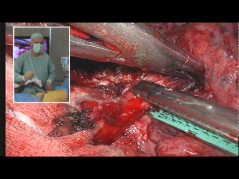 VATS Lobectomy Left Lower Lobe Video