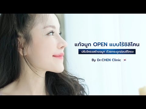 RIB RHINOPLASTY เคสนี้เคยเสริมจมูกมาแล้ว 4 ครั้ง 