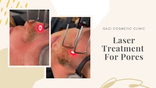 Laser Treatment for Pores by Dr. Nadir Qazi