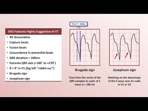 Advanced EKGs - Distinguishing VT from SVT with aberrancy
