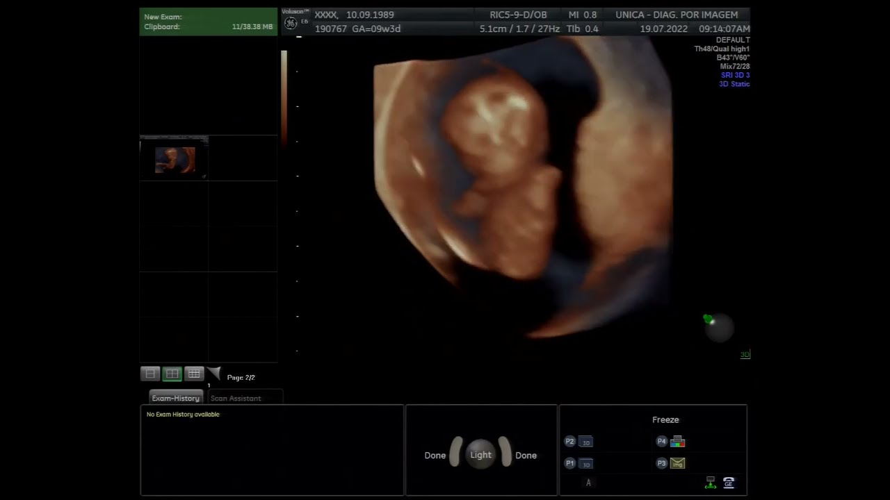 Ultrassom 4D HD Live - 10