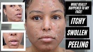 WHAT REALLY HAPPENED TO MY FACE! ITCHY + SWOLLEN + PEELING