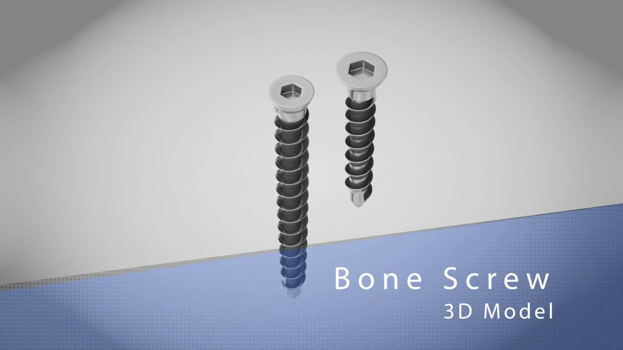 骨螺钉 2 尺寸 - 植入物 3D 模型
