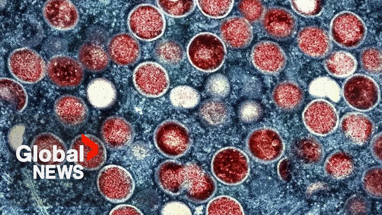 Mpox: What are the symptoms, and how does it spread?