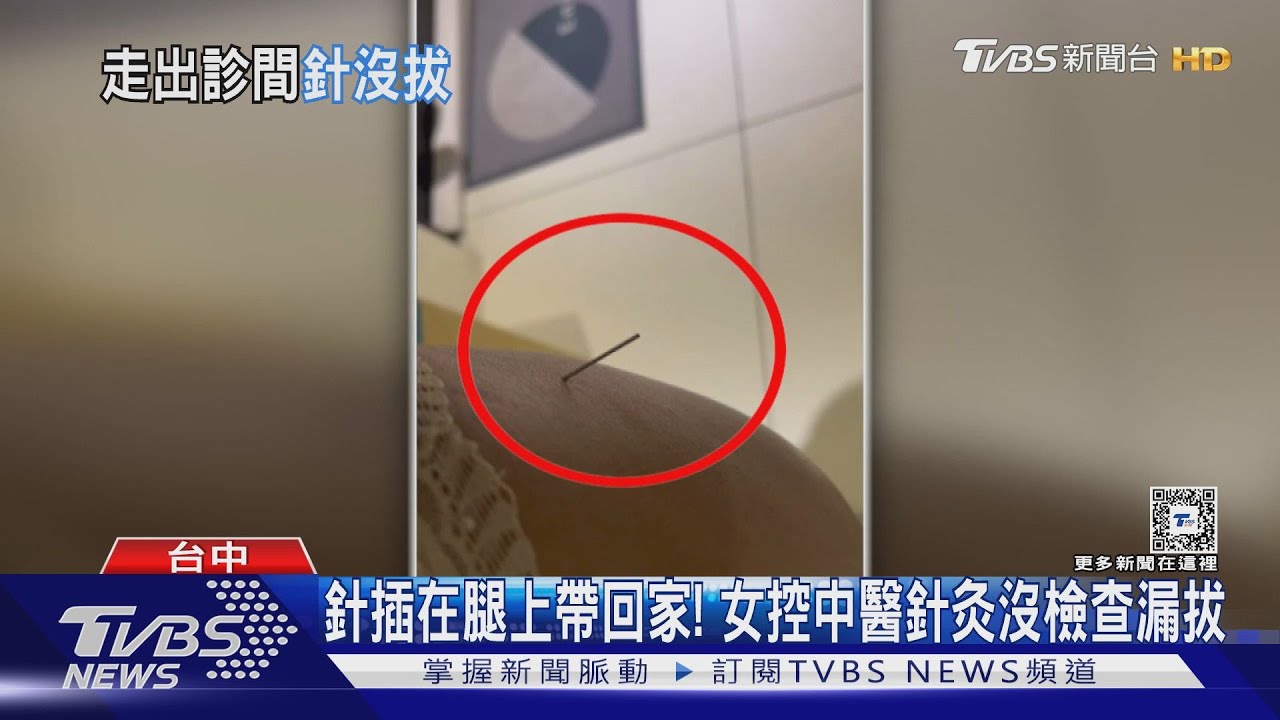 針插在腿上帶回家!女控中醫針灸沒檢查漏拔