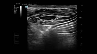 Asvide: Anesthesia procedure steps.