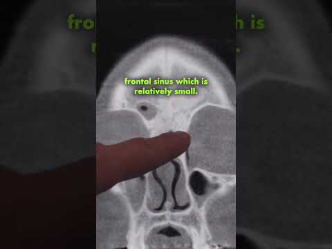 CT Scan of Patient with Chronic Nasal Obstruction