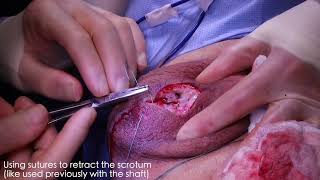 Penis and Scrotum Silicone Injections Removal (GRAPHIC SURGICAL VIDEO)