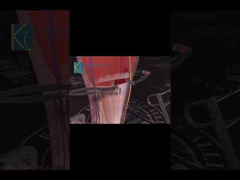 How To Fix Stuck Foot (Equinus)