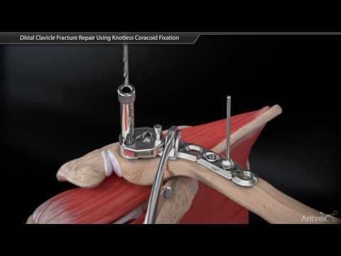 Distal Clavicle Fracture Repair Using Coracoid Fixation