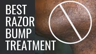 Best DIY Razor Bumps Treatment For Beginners | How to Get Rid of Razor Bumps Fast