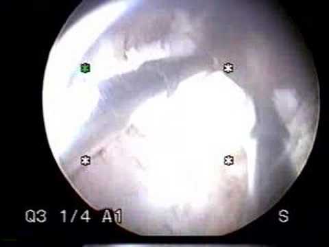 Hysteroscopy - Submucous Leiomyoma (Fibroid)