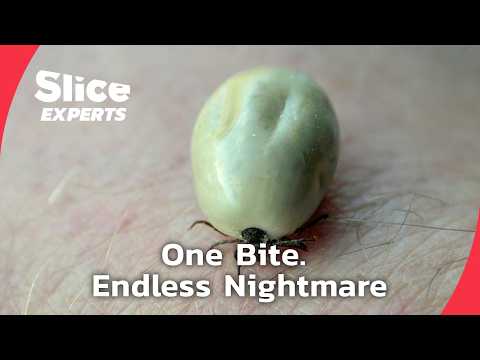 Chronic Pain, No Cure: Inside the Lyme Disease Crisis | SLICE EXPERTS