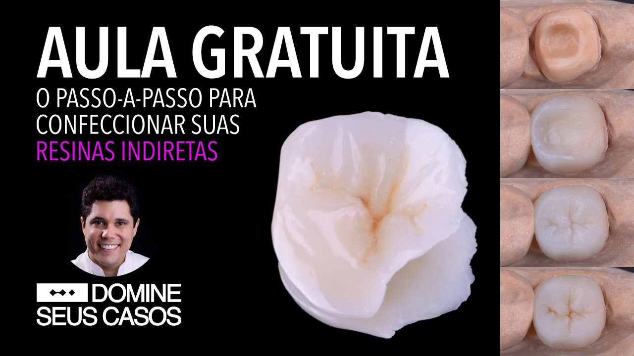 Aula Gratuita - O Passo-a-passo para você confeccionar sua Restauração em Resina Indireta.