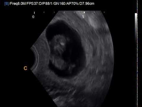 Feto de 11 Semanas Por Ultrasonido Endovaginal