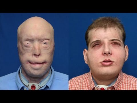 Il pigmentary nota leliminazione da pelle Buona crema contro lentiggini