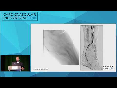 CVI2018 Session: Innovation in PAD and CLI (Aspen Ballroom, July 26, 1:30 pm)