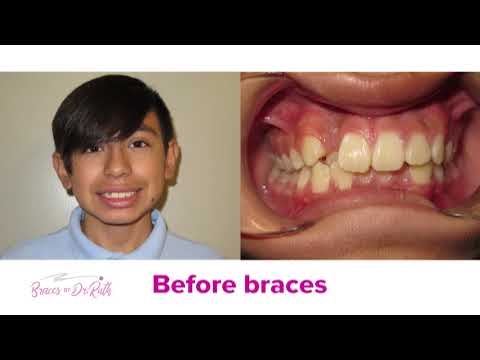 Class I crowding before and after