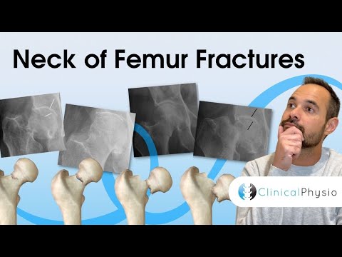 Neck of Femur Fractures | Expert Physio Review