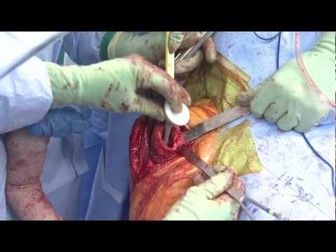 Reverse Total Shoulder Arthroplasty