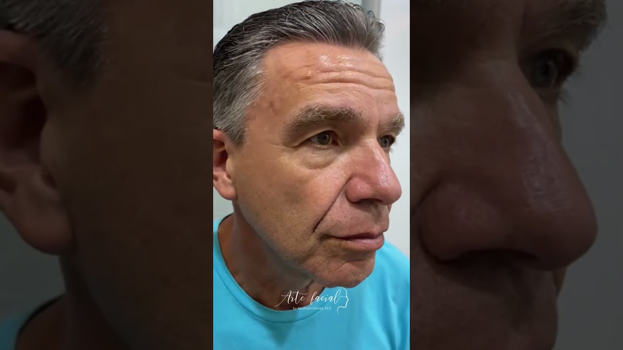 Reparando el párpado caído en hombres