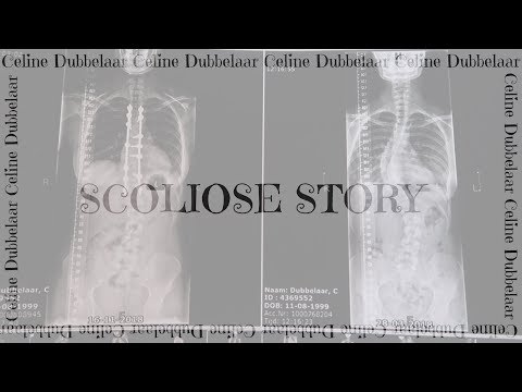Scoliose story aflevering 7 | Eindelijk naar huis!