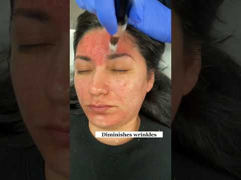 MICRONEEDLING BENEFITS