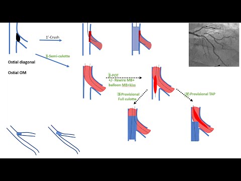 Ostial side branch stenting (esp. ostial diagonal): algorithms and cases -Elias Hanna