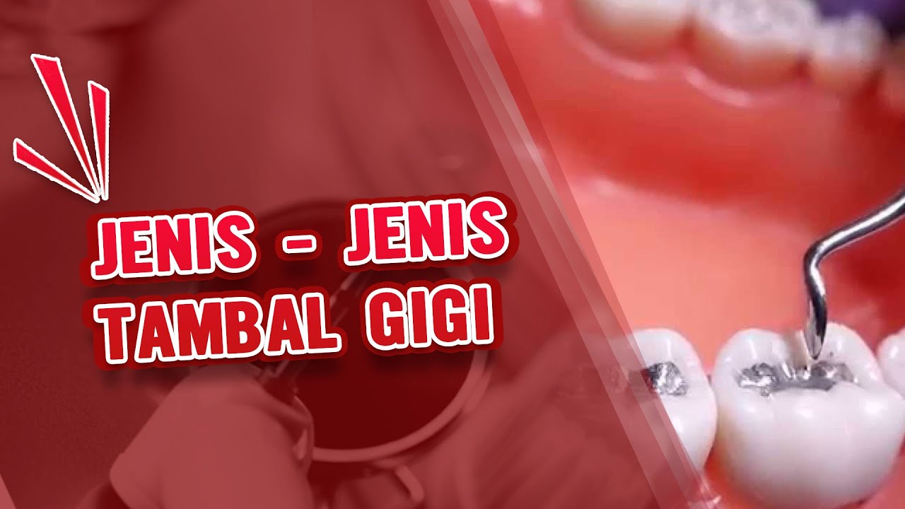 Putar video Jenis Tambal Gigi beserta Keunggulannya - Dental Universe Indonesia sekarang Jenis Tambal Gigi beserta Keunggulannya - Dental Universe Indonesia