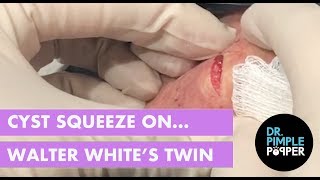 Cyst Squeeze on Walter White&#39;s Twin