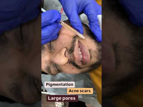 Chemical Peel