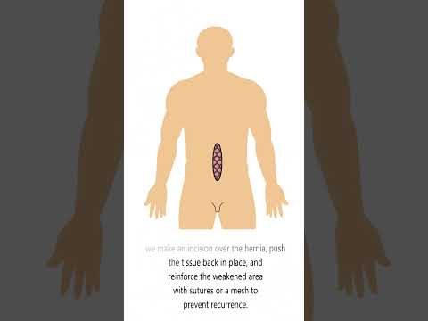 ventral hernia full video