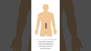 ventral hernia full video