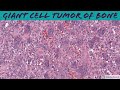 Giant Cell Tumor Of Bone Bone Pathology Basics