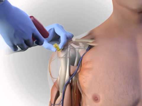 Arrow® EZ-IO® Proximal Humerus Site Animation