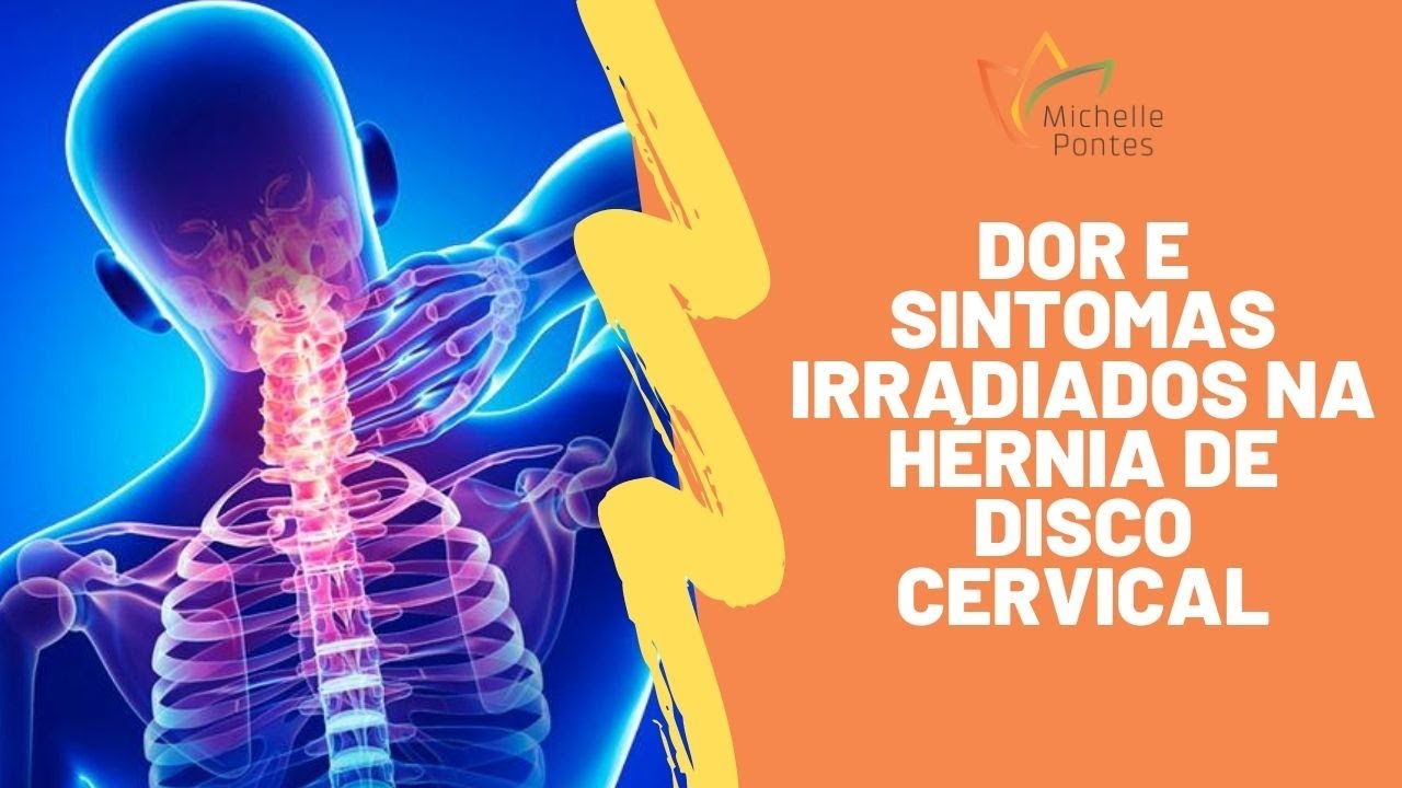 Dor e Sintomas Irradiados na Hérnia de Disco Cervical